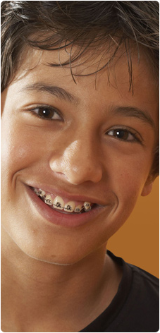 First Days in Braces