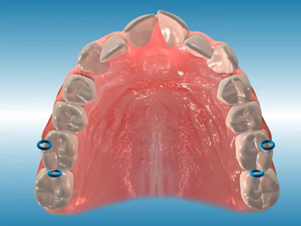 Separator (Spacer)