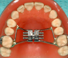 Palatal Expander